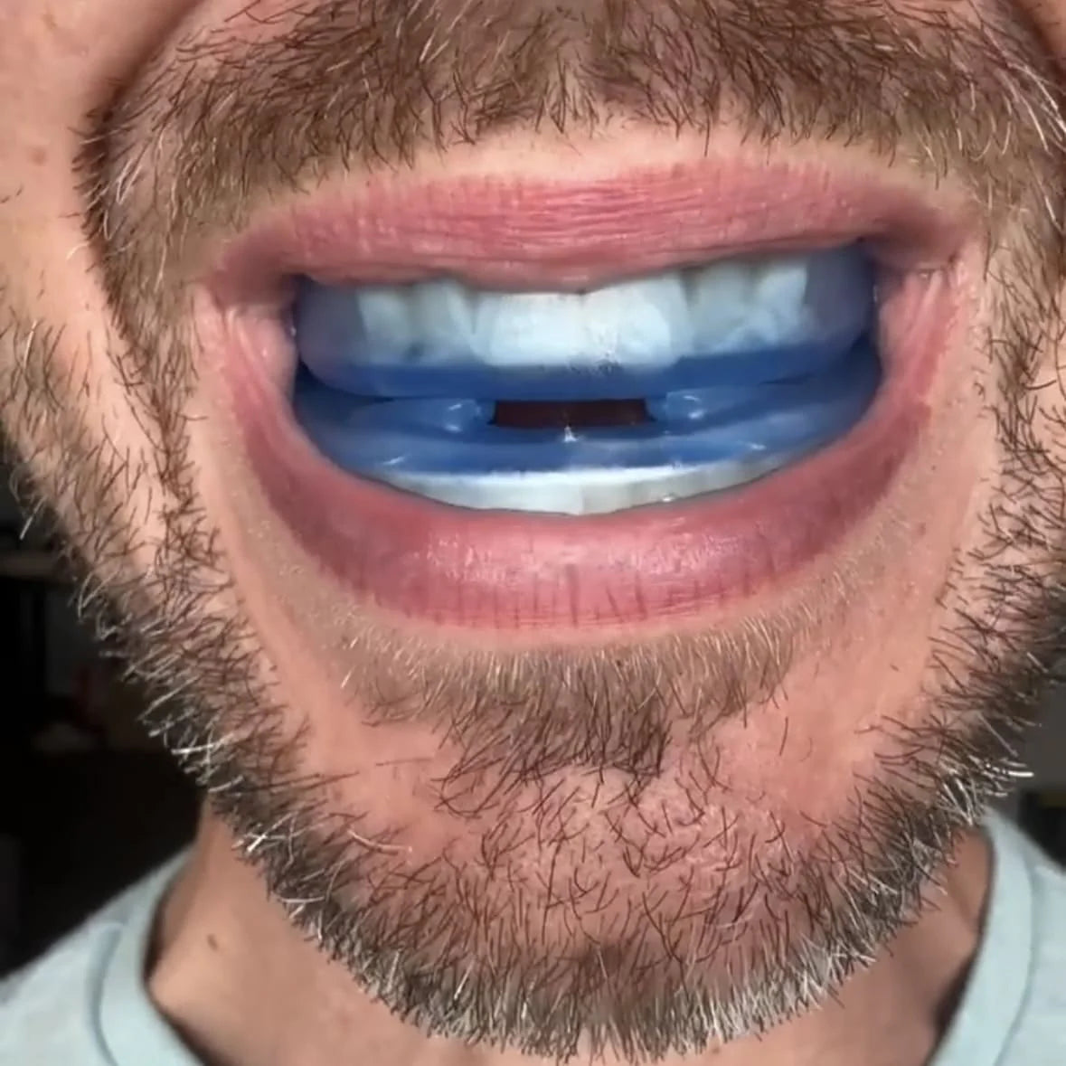 MOONBIFFY™ ANTI SNORING MOUTHPIECE