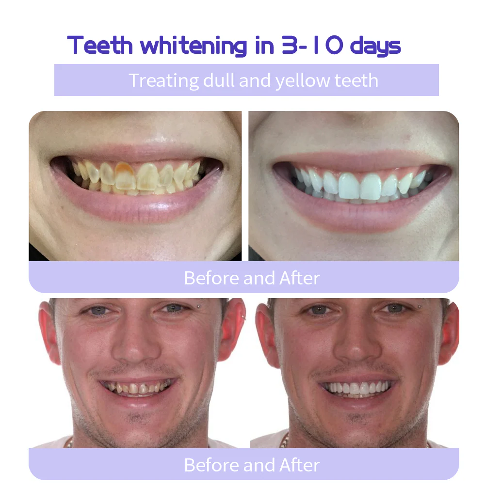 MISSPONE® Teeth Restoration Mineral Powder