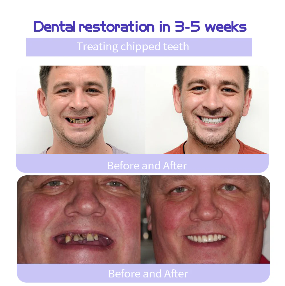 MISSPONE® Teeth Restoration Mineral Powder