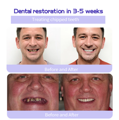 MISSPONE® Teeth Restoration Mineral Powder